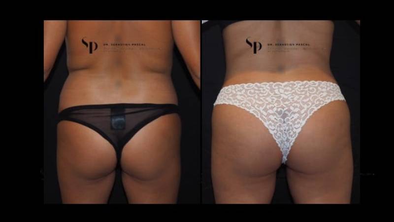 Silhouette - Lipofilling des fesses