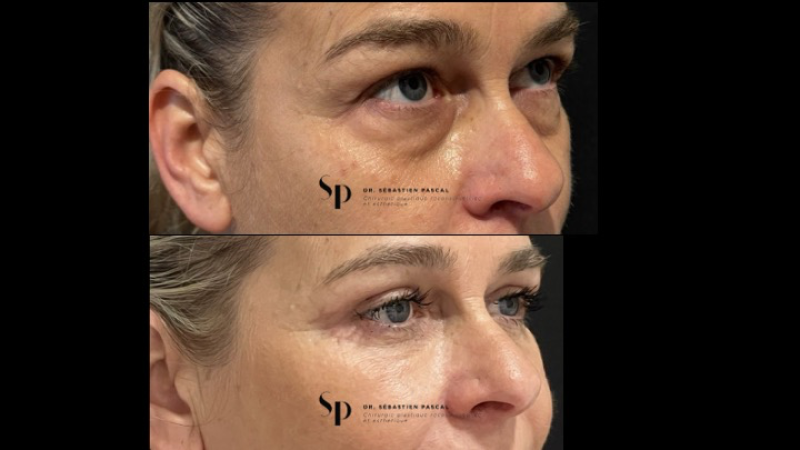 Visage - Blépharoplastie