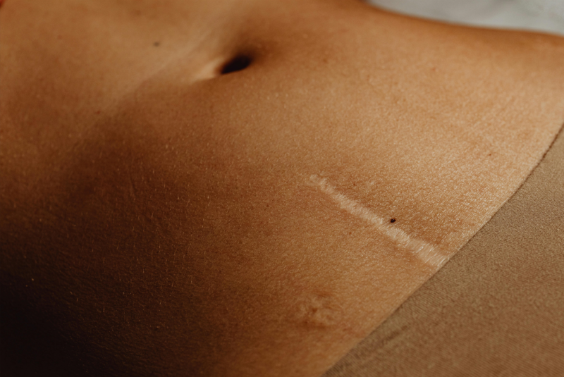 Chirurgie plastique pour traitement et Reprise de Cicatrices