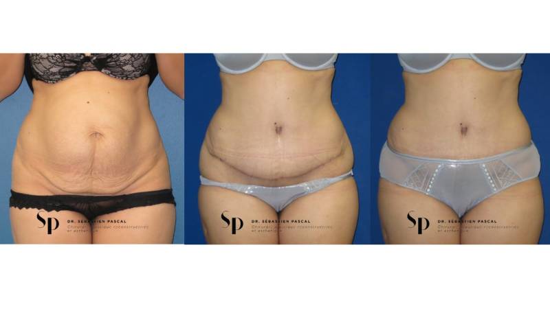 Silhouette - Abdominoplastie ou lifting du ventre