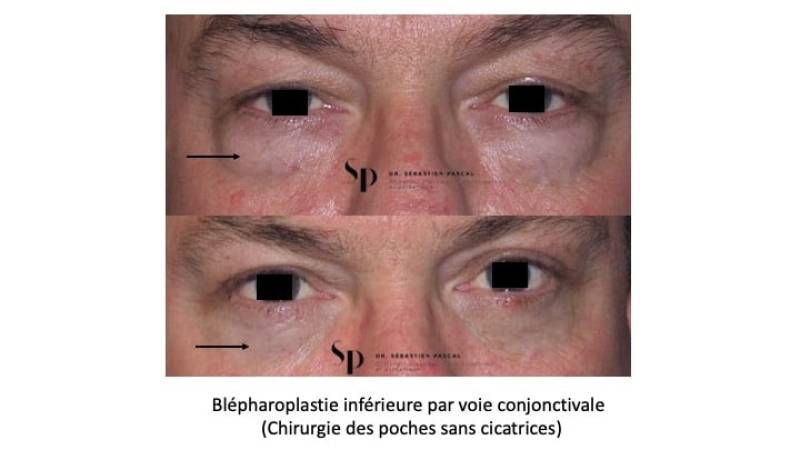 Visage - Blépharoplastie