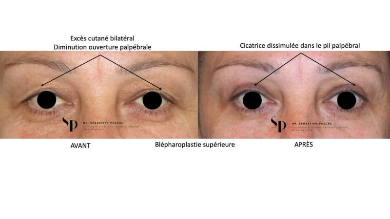 Visage - Blépharoplastie