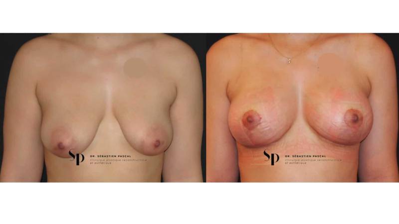 Poitrine - Cure de ptose mammaire SANS PROTHESES