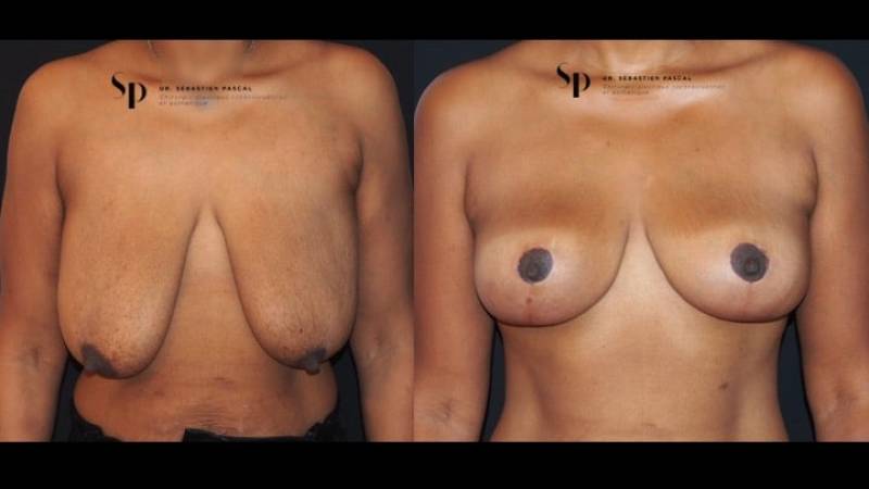 Poitrine - Cure de ptose mammaire SANS PROTHESES