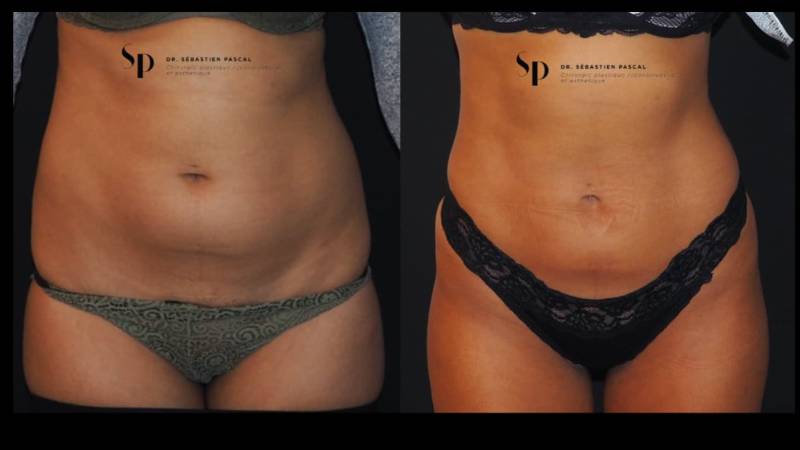 Silhouette - Lipoaspiration ou liposuccion