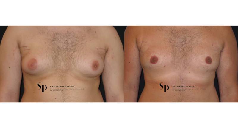 Homme - Gynécomastie