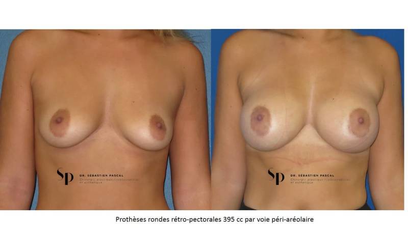Poitrine – Augmentation mammaire par prothèse