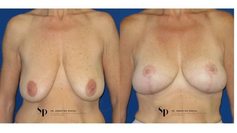 Poitrine - Cure de ptose mammaire SANS PROTHESES