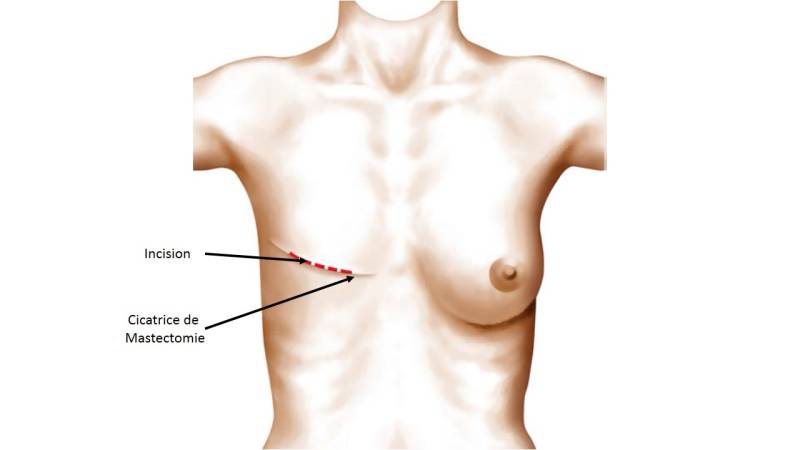 Reconstruction Mammaire par Prothèse