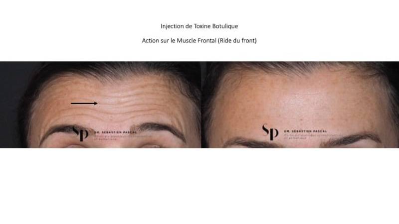Visage - Injection de Botox