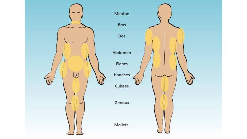 La chirurgie de l’homme La Lipoaspiration ou Liposuccion