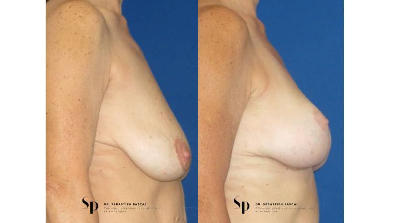 Poitrine - Cure de ptose mammaire SANS PROTHESES
