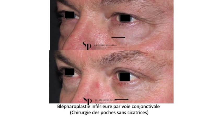Visage - Blépharoplastie