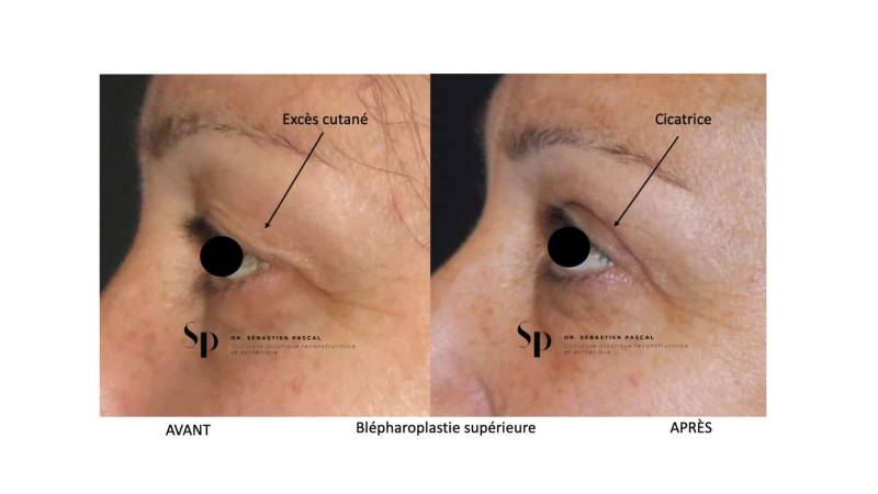 Visage - Blépharoplastie