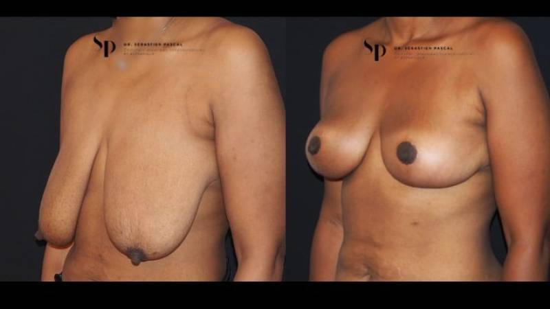 Poitrine - Cure de ptose mammaire SANS PROTHESES