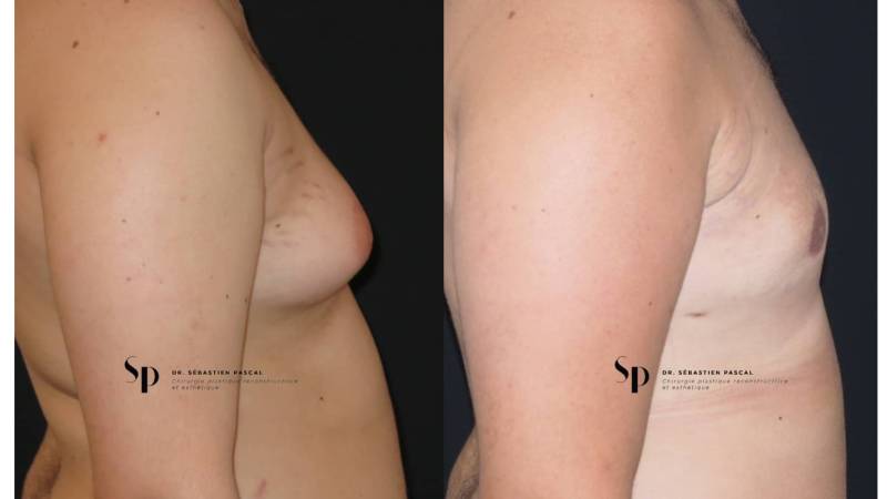 Homme - Gynécomastie