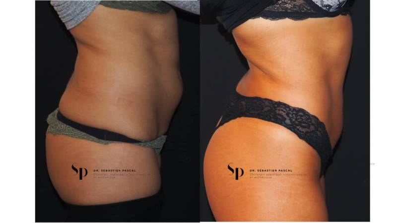 Silhouette - Lipoaspiration ou liposuccion
