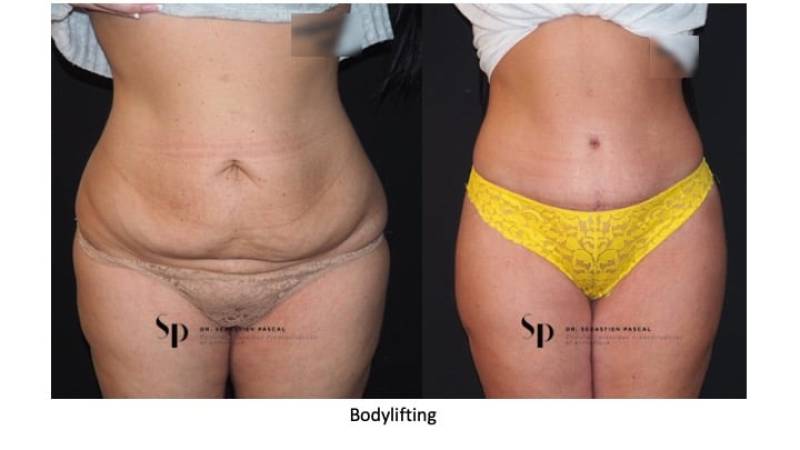 Silhouette - Bodylift