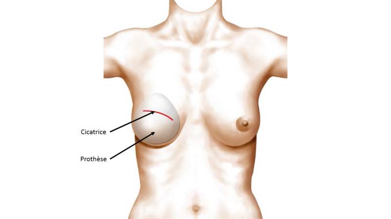 Reconstruction Mammaire par Prothèse