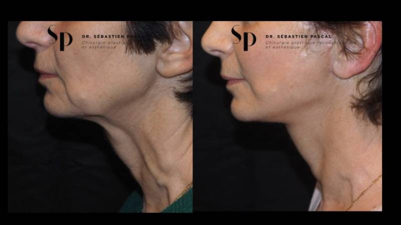 Visage - Lifting Cervico-Facial