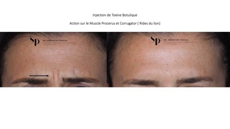 Visage - Injection de Botox