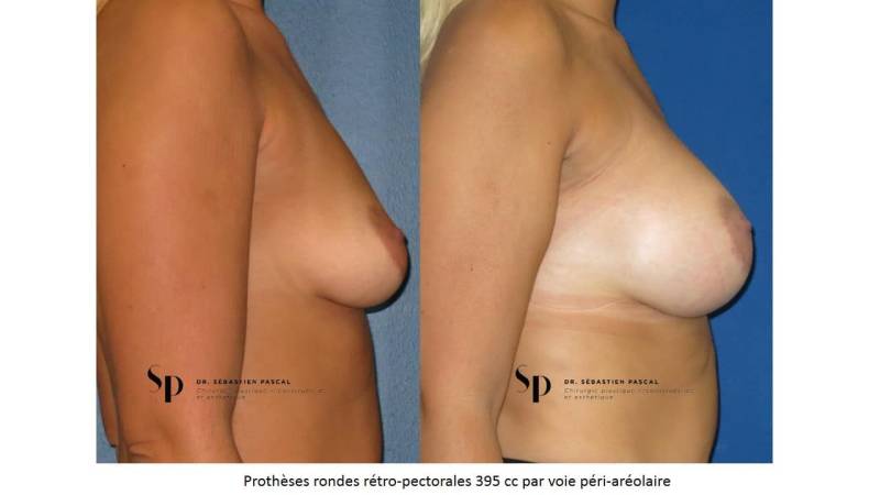 Poitrine – Augmentation mammaire par prothèse
