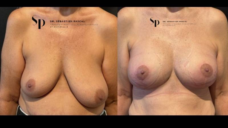 Poitrine - Cure de ptose mammaire AVEC PROTHESES (2)