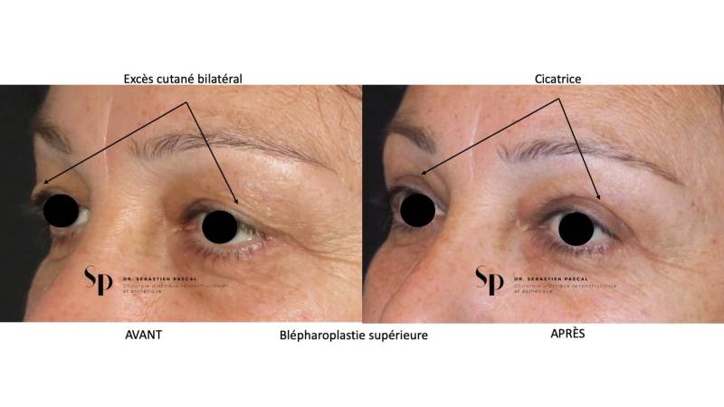 Visage - Blépharoplastie