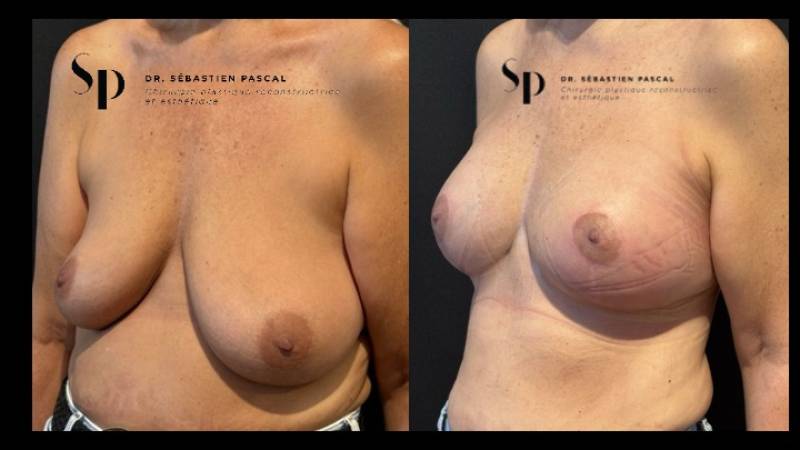 Poitrine - Cure de ptose mammaire AVEC PROTHESES (2)