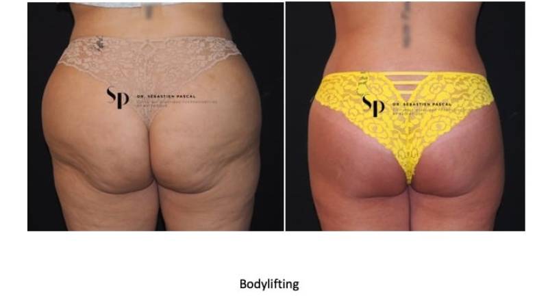 Silhouette - Bodylift