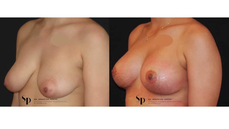 Poitrine - Cure de ptose mammaire SANS PROTHESES