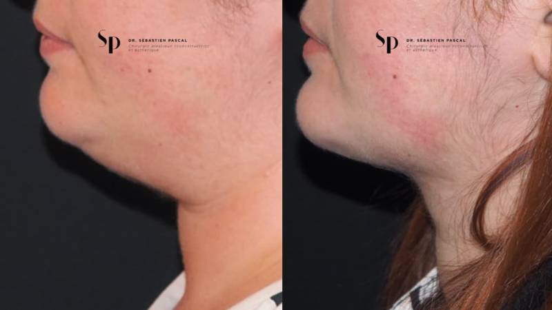 Visage - Lipoaspiration du cou