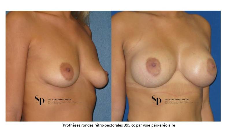 Poitrine – Augmentation mammaire par prothèse
