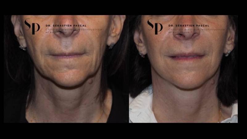 Visage - Lifting Cervico-Facial