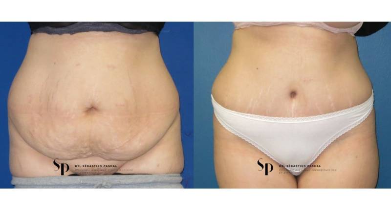 Silhouette - Abdominoplastie ou lifting du ventre