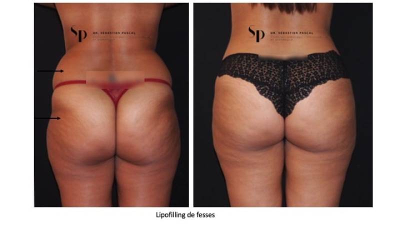 Silhouette - Lipofilling des fesses