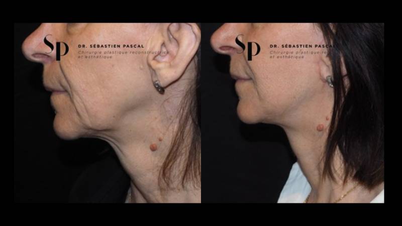 Visage - Lifting Cervico-Facial