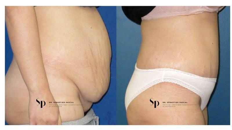 Silhouette - Abdominoplastie ou lifting du ventre