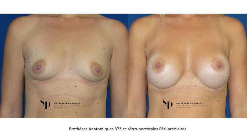 Poitrine – Augmentation mammaire par prothèse