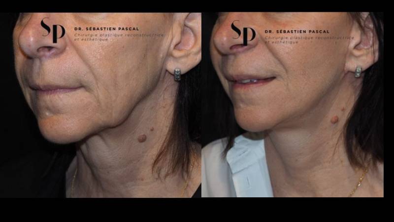 Visage - Lifting Cervico-Facial