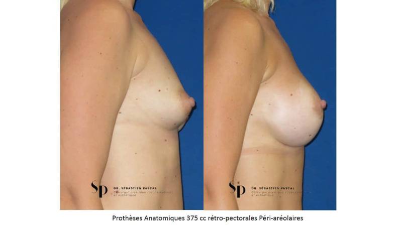 Poitrine – Augmentation mammaire par prothèse