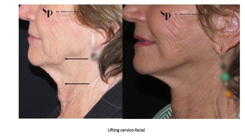 Visage - Lifting Cervico-Facial