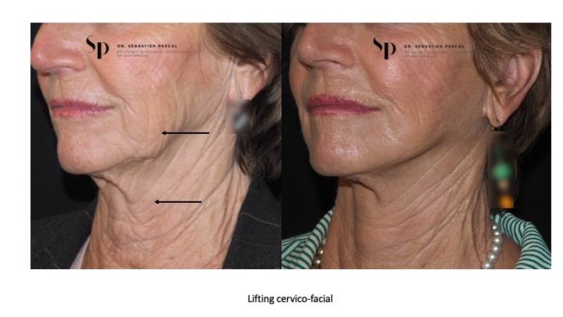 Visage - Lifting Cervico-Facial
