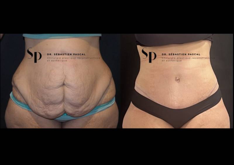 Silhouette - Bodylift