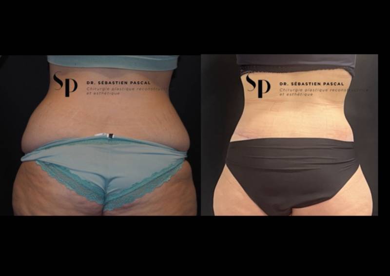 Silhouette - Bodylift