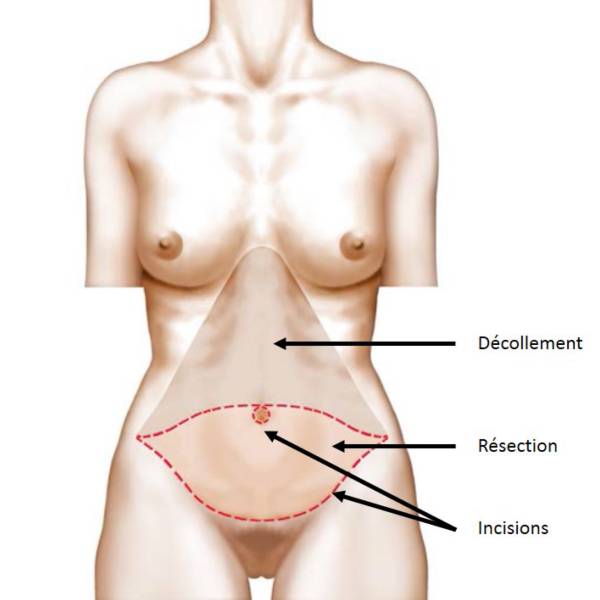 Abdominoplastie ou Lifting du Ventre