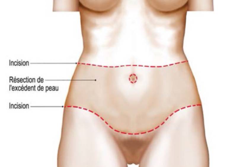Bodylift ou Dermolipectomie Totale Circulaire