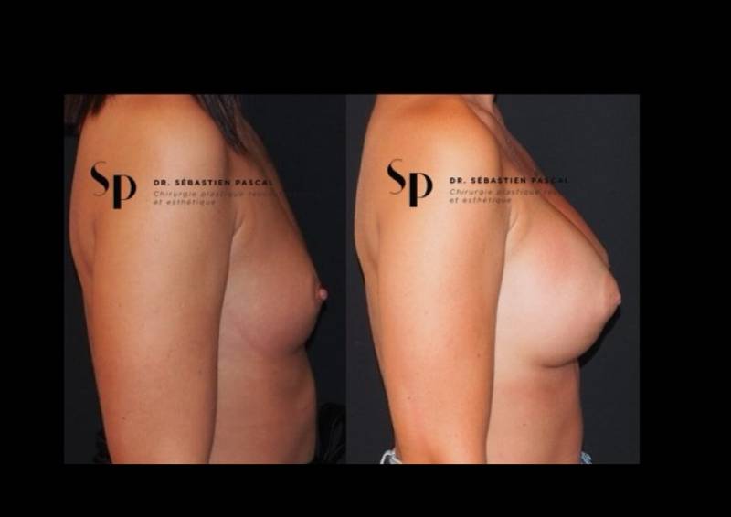 Poitrine – Augmentation mammaire par prothèse (3)