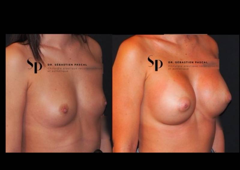 Poitrine – Augmentation mammaire par prothèse (3)