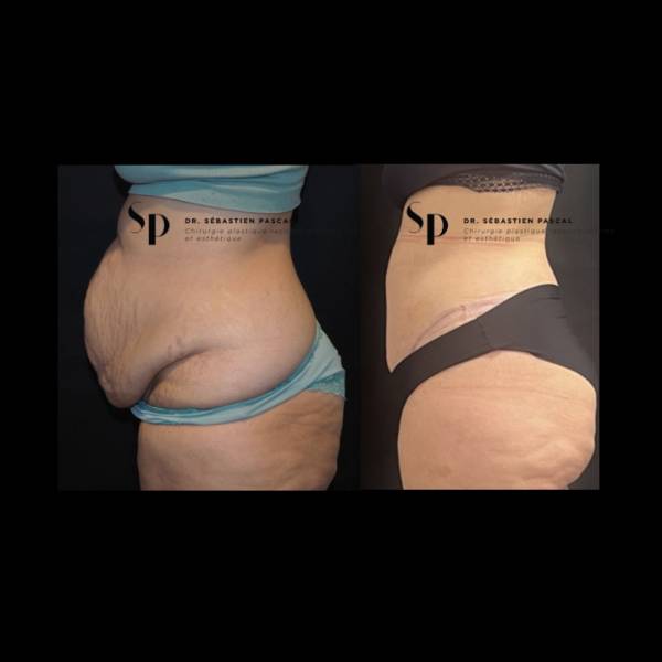 Silhouette - Abdominoplastie ou lifting du ventre